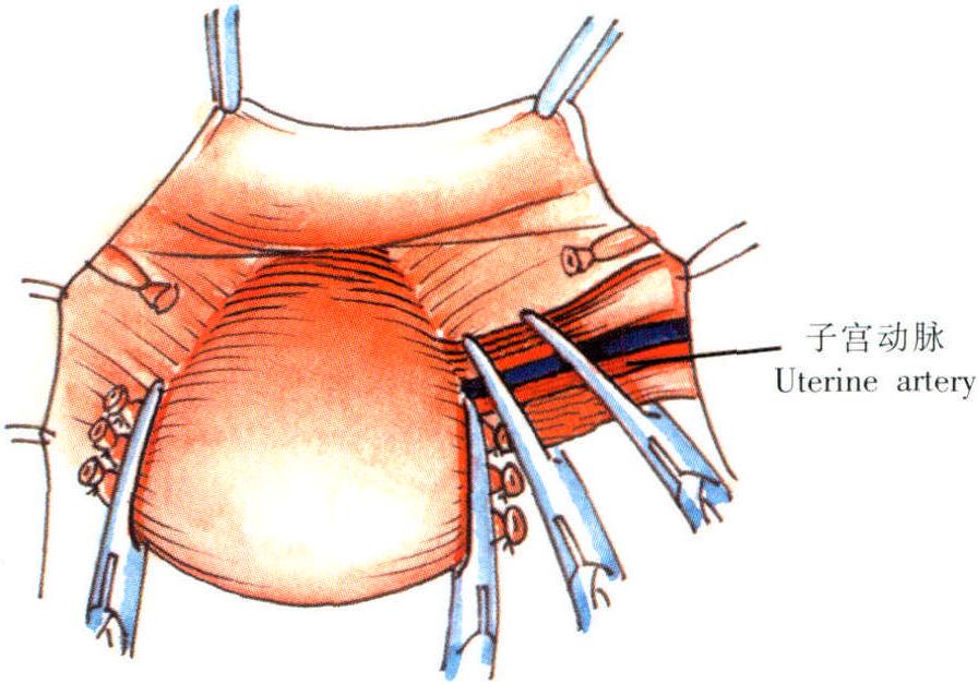 筋膜外全子宫切除术